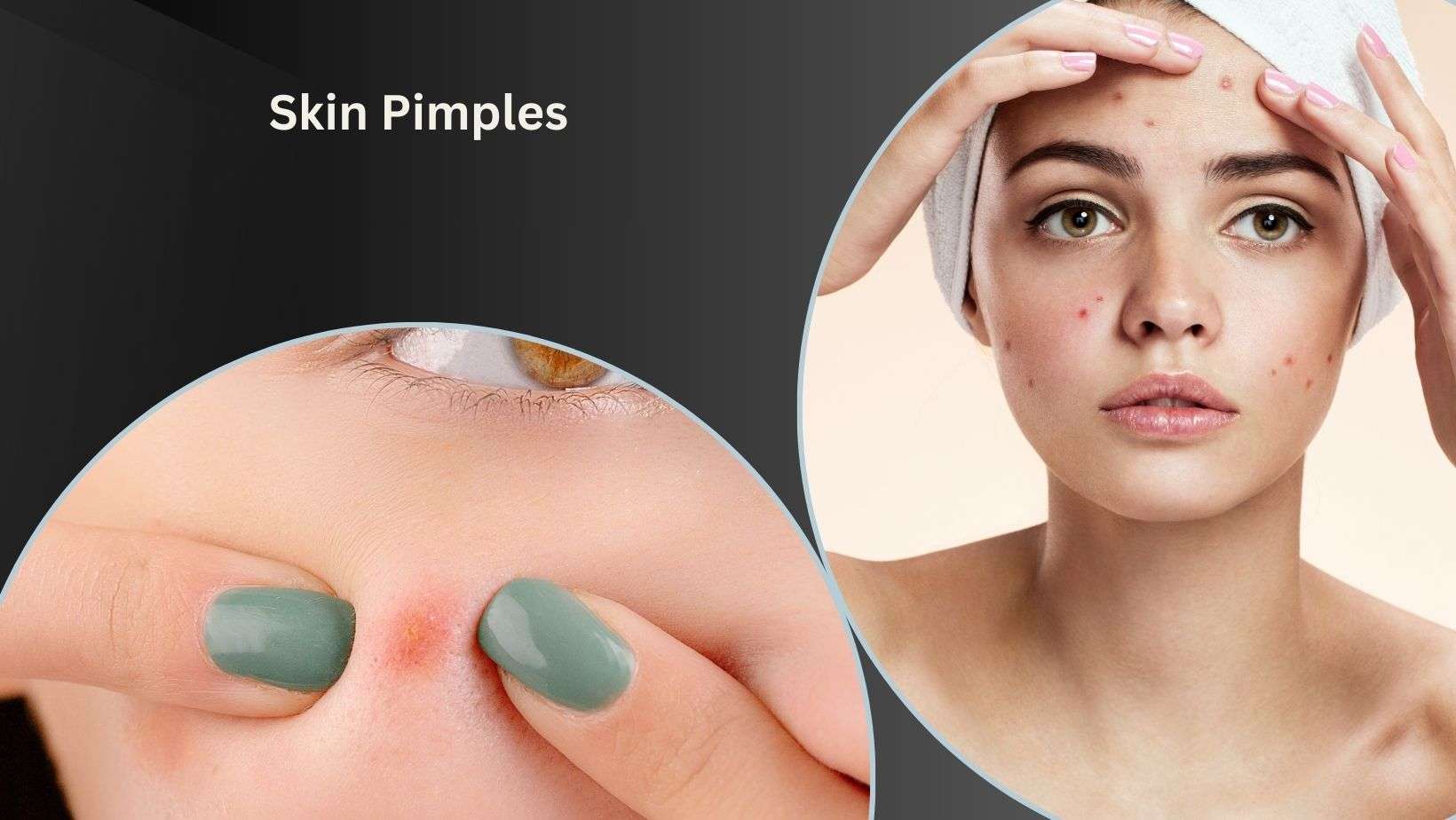Skin Pimples